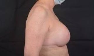 Immediate Breast Reconstruction – Nipple Sparing Before & After Gallery - Patient 351464 - Image 6
