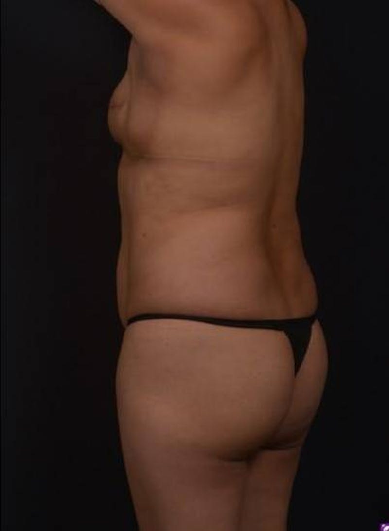 Brazillian Butt Lift Before & After Gallery - Patient 209829 - Image 7