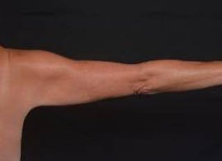 BodyTite Arms Before & After Gallery - Patient 386112 - Image 8