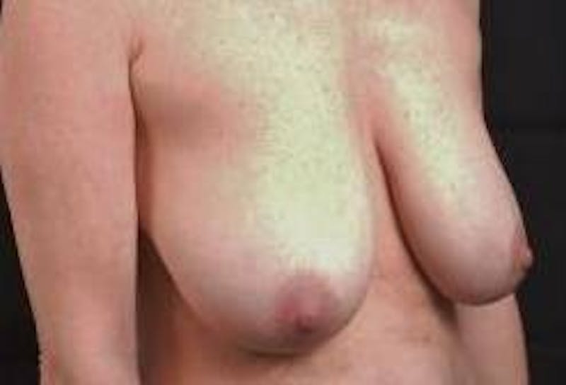 Mastopexy Before & After Gallery - Patient 159407 - Image 9