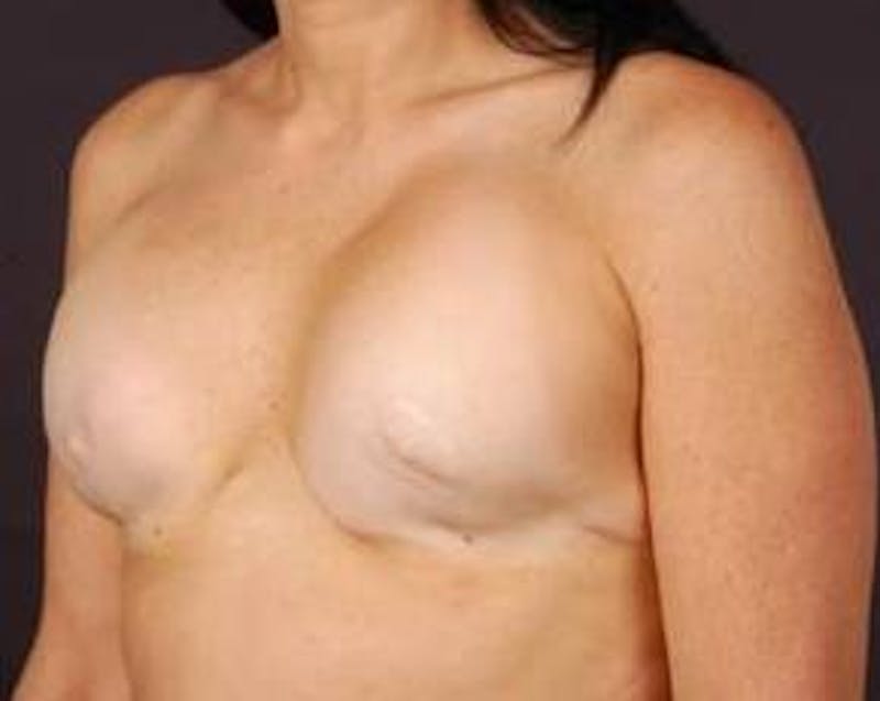 Reconstructive Breast Revision Before & After Gallery - Patient 205783 - Image 3