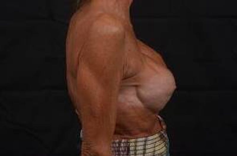 Aesthetic Breast Revision Before & After Gallery - Patient 903974 - Image 5