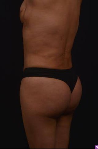 Brazillian Butt Lift Before & After Gallery - Patient 209829 - Image 8
