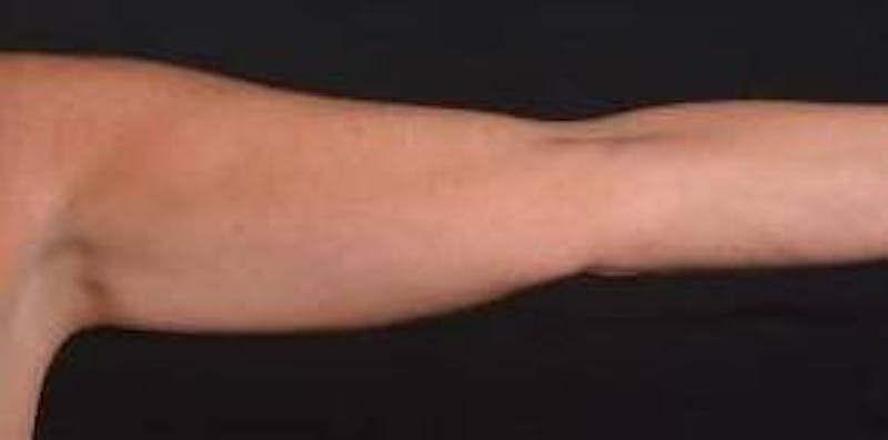 BodyTite Arms Before & After Gallery - Patient 223450 - Image 3