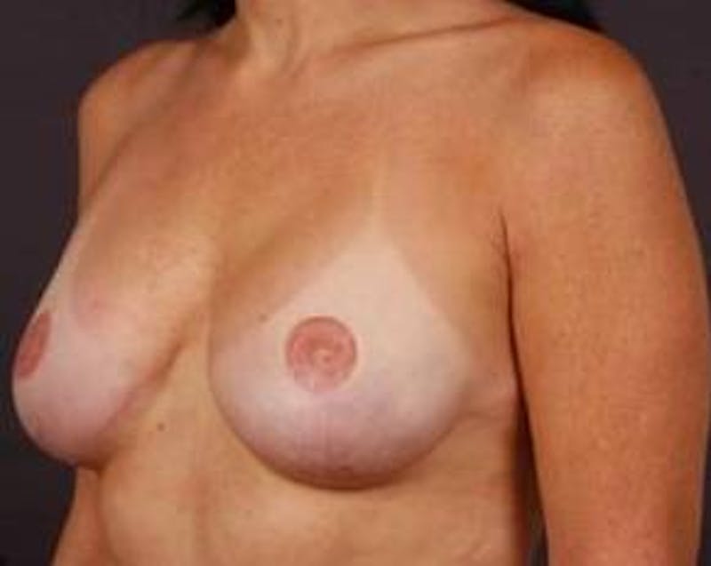 Reconstructive Breast Revision Before & After Gallery - Patient 205783 - Image 4