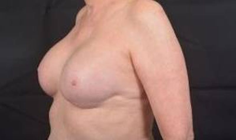 Immediate Breast Reconstruction – Nipple Sparing Before & After Gallery - Patient 351464 - Image 8
