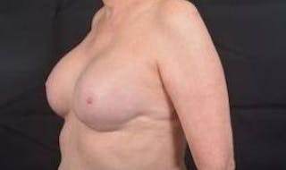 Immediate Breast Reconstruction – Nipple Sparing Before & After Gallery - Patient 351464 - Image 8