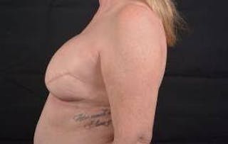 Immediate Breast Reconstruction – Skin Sparing Before & After Gallery - Patient 367060 - Image 4