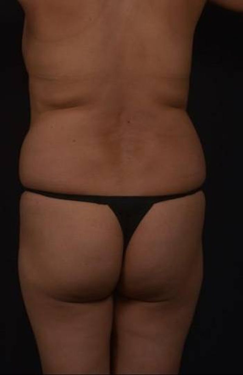 Brazillian Butt Lift Before & After Gallery - Patient 209829 - Image 9