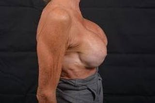 Aesthetic Breast Revision Before & After Gallery - Patient 903974 - Image 6