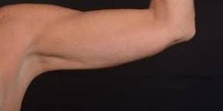 BodyTite Arms Before & After Gallery - Patient 223450 - Image 4