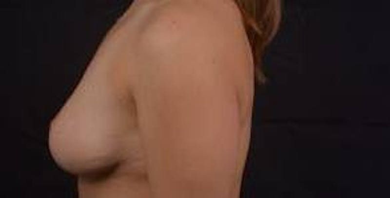 Mastopexy Before & After Gallery - Patient 809175 - Image 4