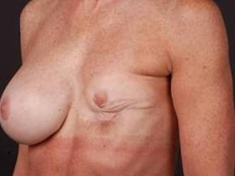 Reconstructive Breast Revision Before & After Gallery - Patient 129838 - Image 3