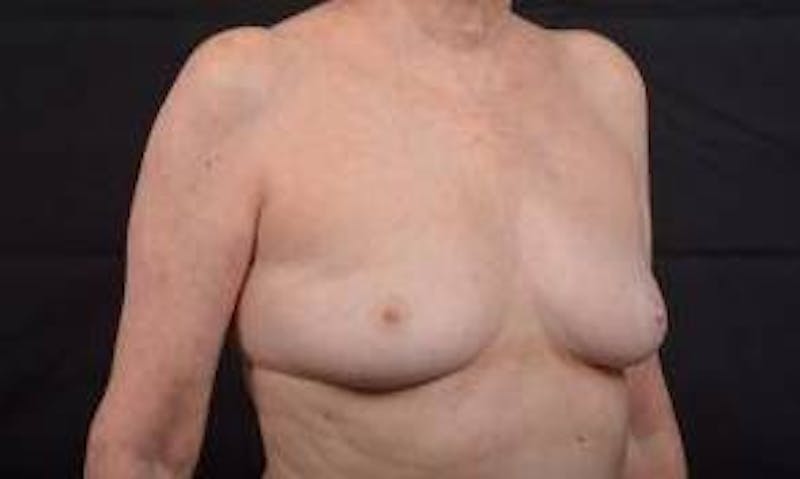 Immediate Breast Reconstruction – Nipple Sparing Before & After Gallery - Patient 351464 - Image 9