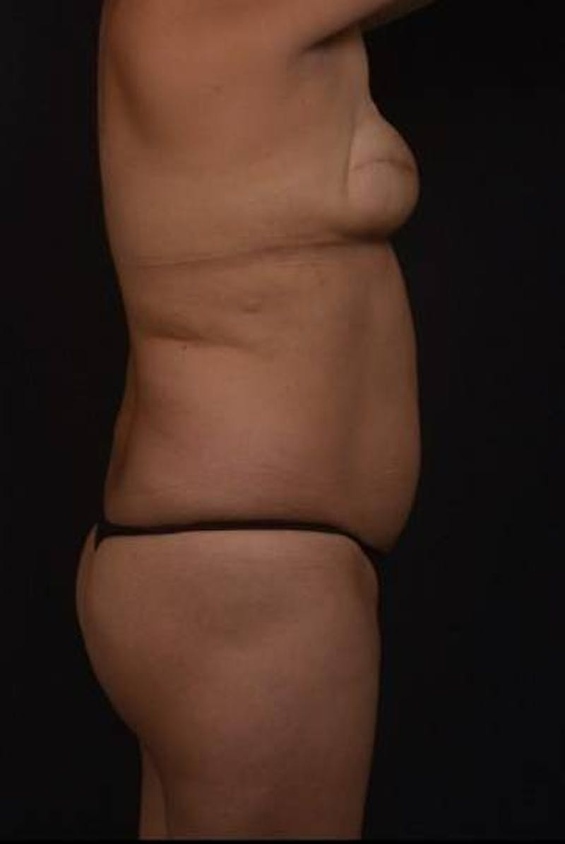 Brazillian Butt Lift Before & After Gallery - Patient 209829 - Image 13