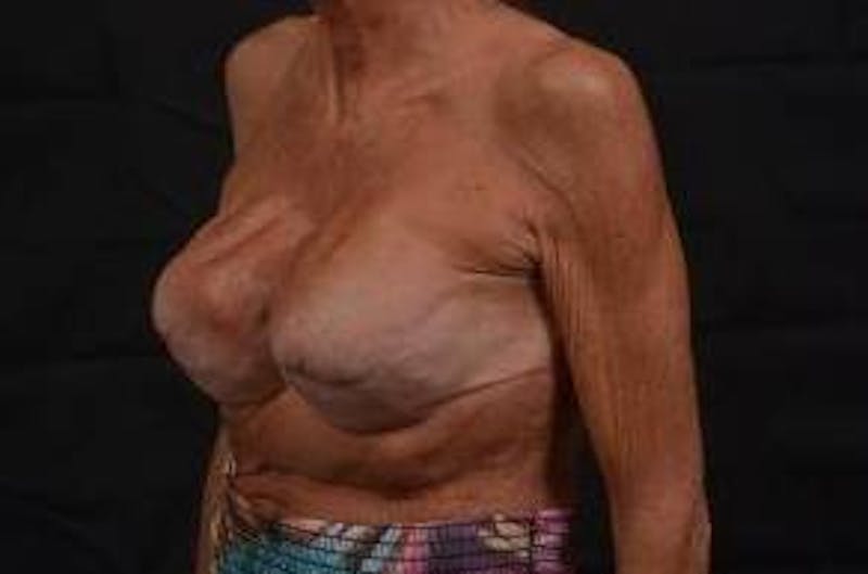 Aesthetic Breast Revision Before & After Gallery - Patient 903974 - Image 7