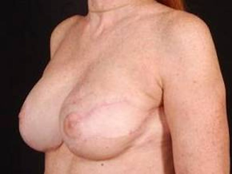 Reconstructive Breast Revision Before & After Gallery - Patient 129838 - Image 4