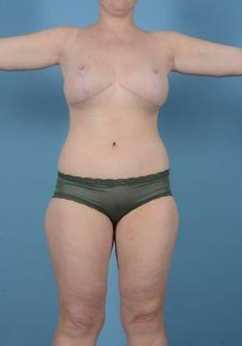 Thigh Lift Before & After Gallery - Patient 281473 - Image 2