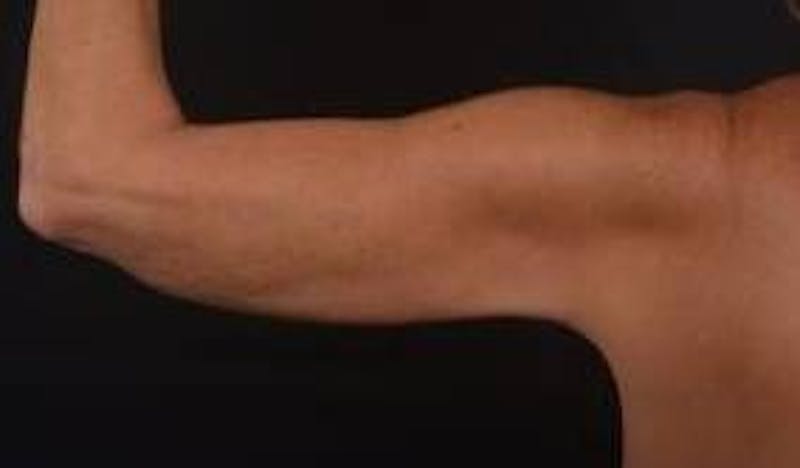 BodyTite Arms Before & After Gallery - Patient 223450 - Image 5