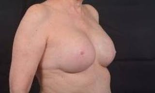 Immediate Breast Reconstruction – Nipple Sparing Before & After Gallery - Patient 351464 - Image 10