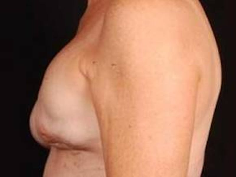 Reconstructive Breast Revision Before & After Gallery - Patient 150834 - Image 3
