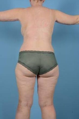 Thigh Lift Before & After Gallery - Patient 281473 - Image 4