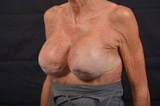 Aesthetic Breast Revision Before & After Gallery - Patient 903974 - Image 8