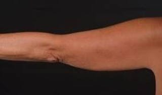 BodyTite Arms Before & After Gallery - Patient 223450 - Image 6