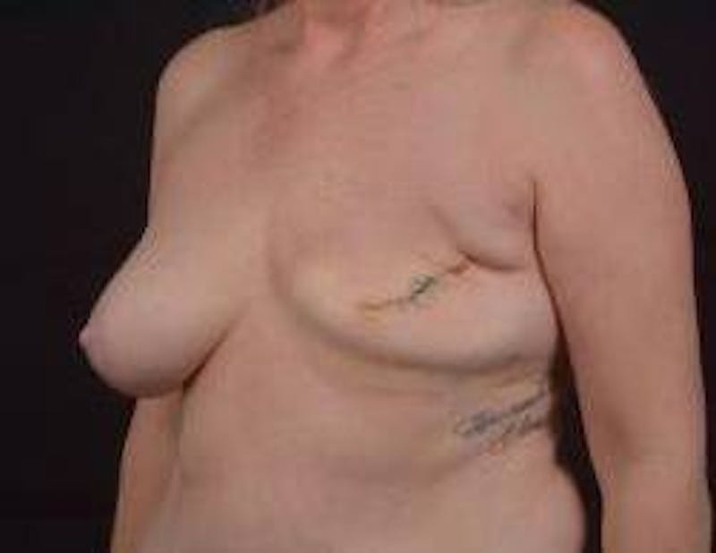 Immediate Breast Reconstruction – Skin Sparing Before & After Gallery - Patient 367060 - Image 7