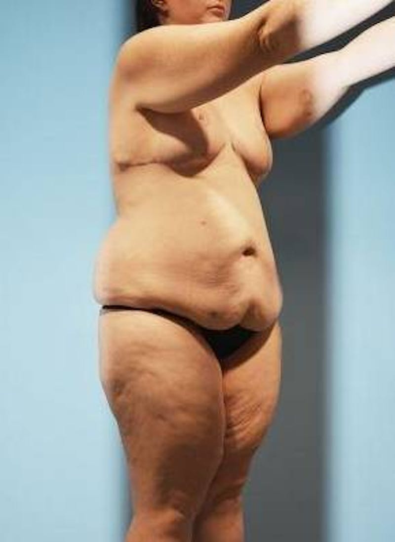 Thigh Lift Before & After Gallery - Patient 281473 - Image 5
