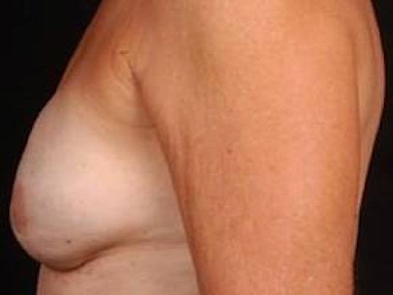 Reconstructive Breast Revision Before & After Gallery - Patient 150834 - Image 4