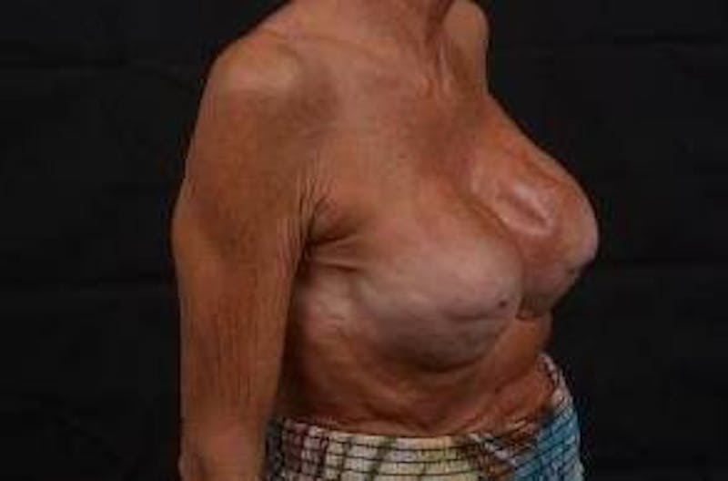 Aesthetic Breast Revision Before & After Gallery - Patient 903974 - Image 9