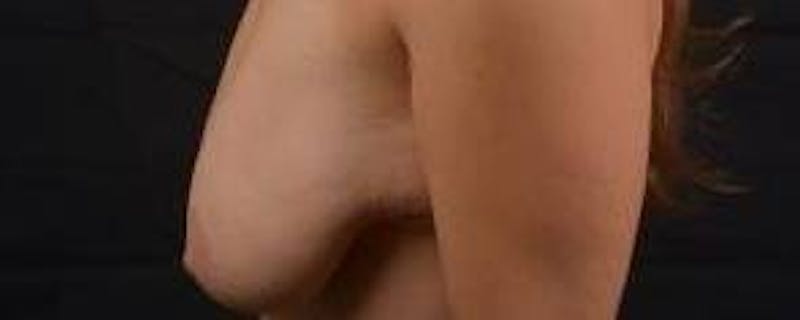 Mastopexy Before & After Gallery - Patient 185322 - Image 3