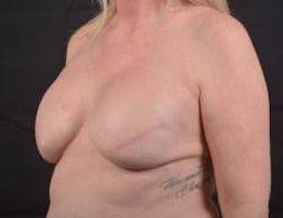 Immediate Breast Reconstruction – Skin Sparing Before & After Gallery - Patient 367060 - Image 8