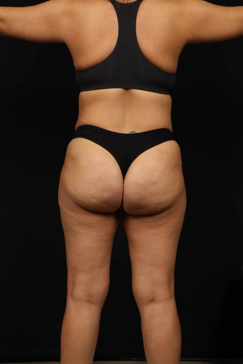 Brazillian Butt Lift Before & After Gallery - Patient 342295 - Image 5