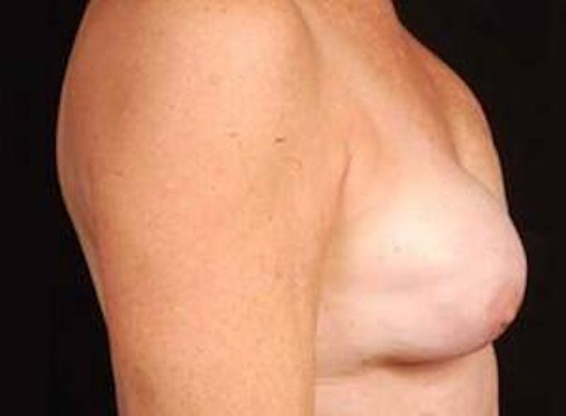 Reconstructive Breast Revision Before & After Gallery - Patient 150834 - Image 5