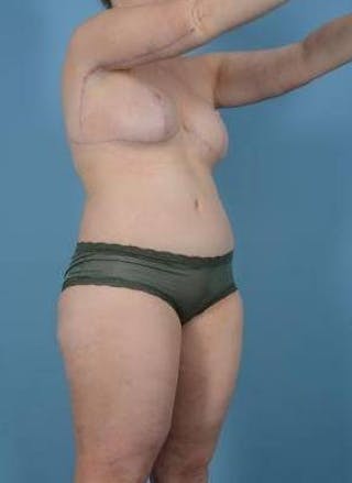 Thigh Lift Before & After Gallery - Patient 281473 - Image 6