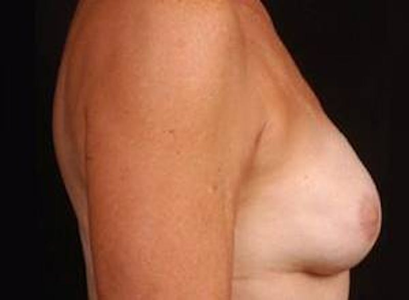 Reconstructive Breast Revision Before & After Gallery - Patient 150834 - Image 6
