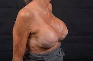 Aesthetic Breast Revision Before & After Gallery - Patient 903974 - Image 10