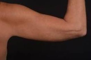 BodyTite Arms Before & After Gallery - Patient 223450 - Image 8