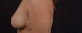 Mastopexy Before & After Gallery - Patient 185322 - Image 4