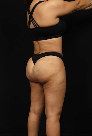 Brazillian Butt Lift Before & After Gallery - Patient 342295 - Image 8