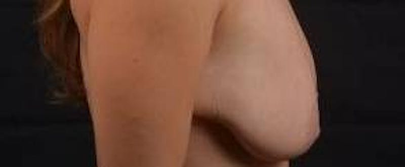 Mastopexy Before & After Gallery - Patient 185322 - Image 5