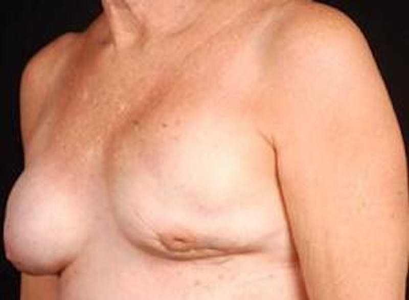 Reconstructive Breast Revision Before & After Gallery - Patient 150834 - Image 7