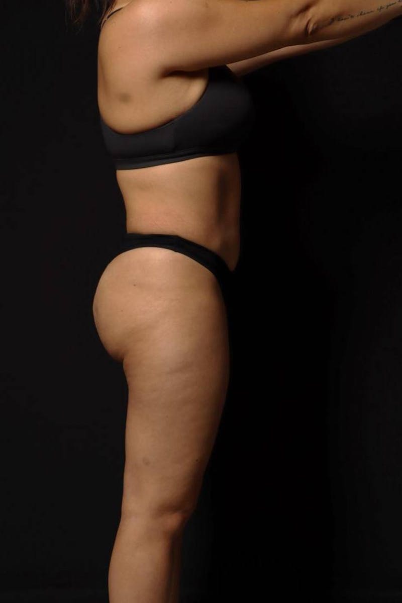 Brazillian Butt Lift Before & After Gallery - Patient 342295 - Image 9