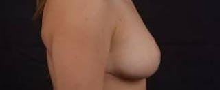 Mastopexy Before & After Gallery - Patient 185322 - Image 6