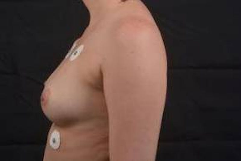 Immediate Breast Reconstruction – Skin Sparing Before & After Gallery - Patient 150575 - Image 3