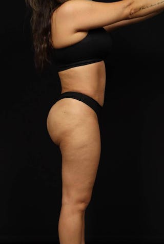 Brazillian Butt Lift Before & After Gallery - Patient 342295 - Image 10