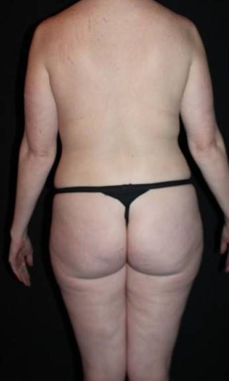 360 Liposuction Before & After Gallery - Patient 153794 - Image 7