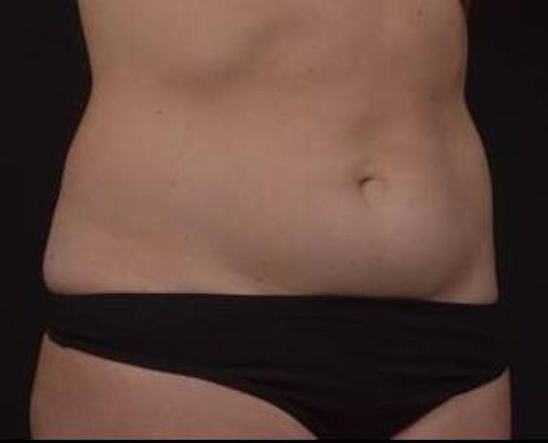 Brazillian Butt Lift Before & After Gallery - Patient 588091 - Image 3